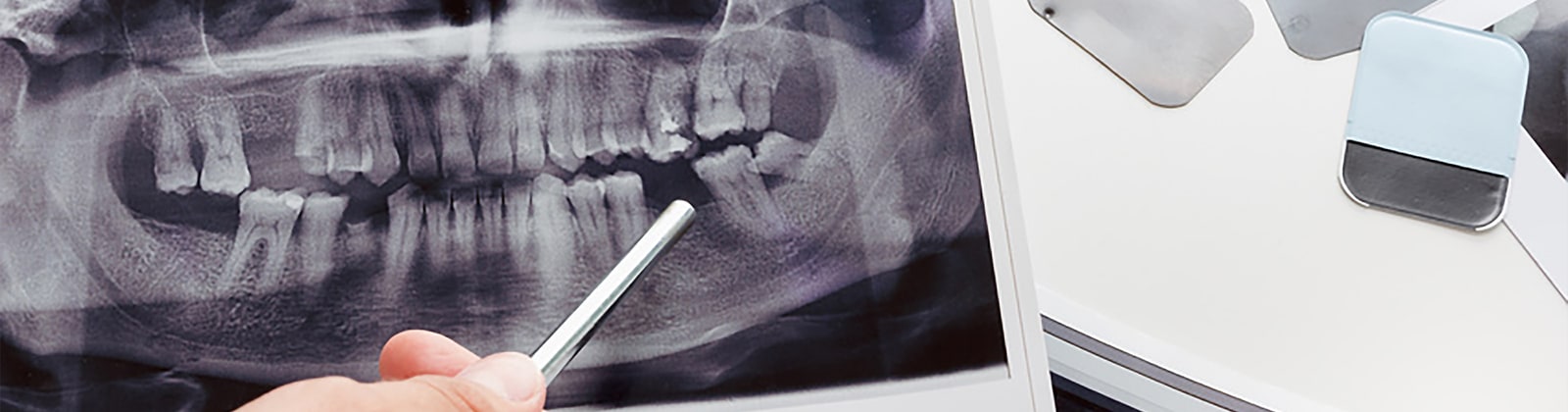 下顎の奥歯のインプラントができないと言われるケース